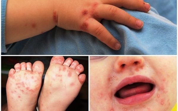 Bệnh chân tay miệng khác bệnh đậu mùa khỉ như thế nào?
